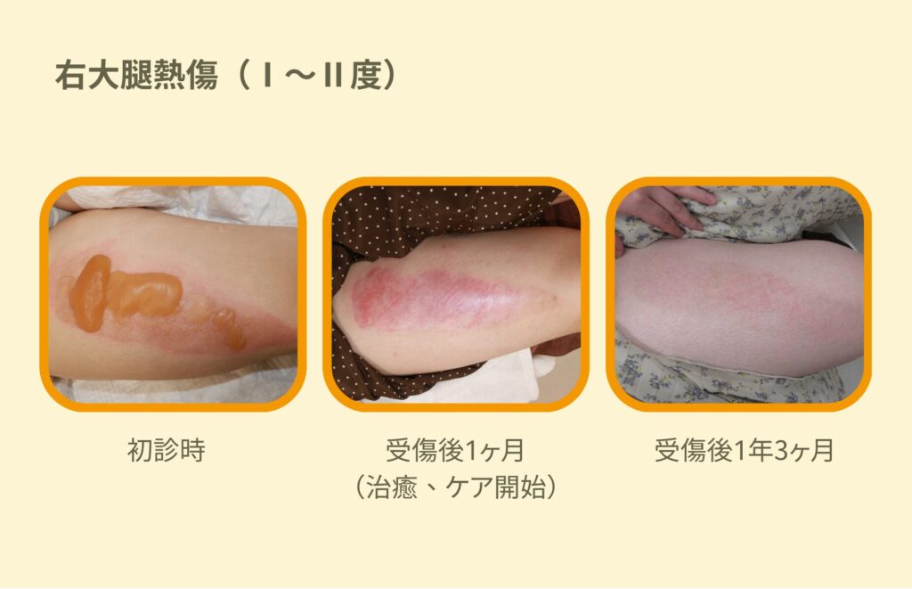 右大腿熱傷後未成熟瘢痕