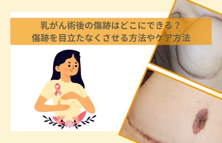 乳がん術後の傷跡はどこにできる？傷跡を目立たなくさせる方法やケア方法